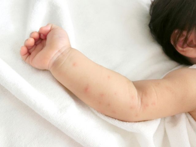 湿疹の出た赤ちゃんの腕